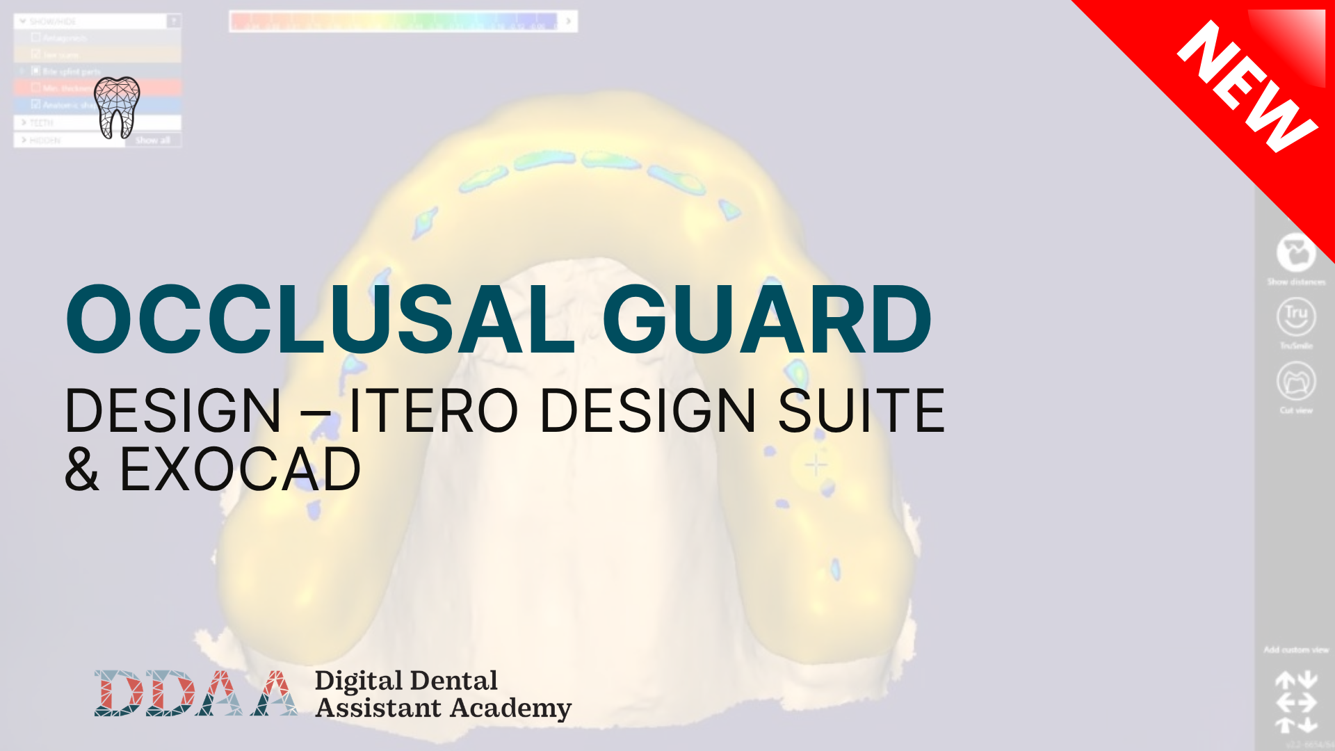 Occlusal Guard Design – Itero Design Suite & Exocad